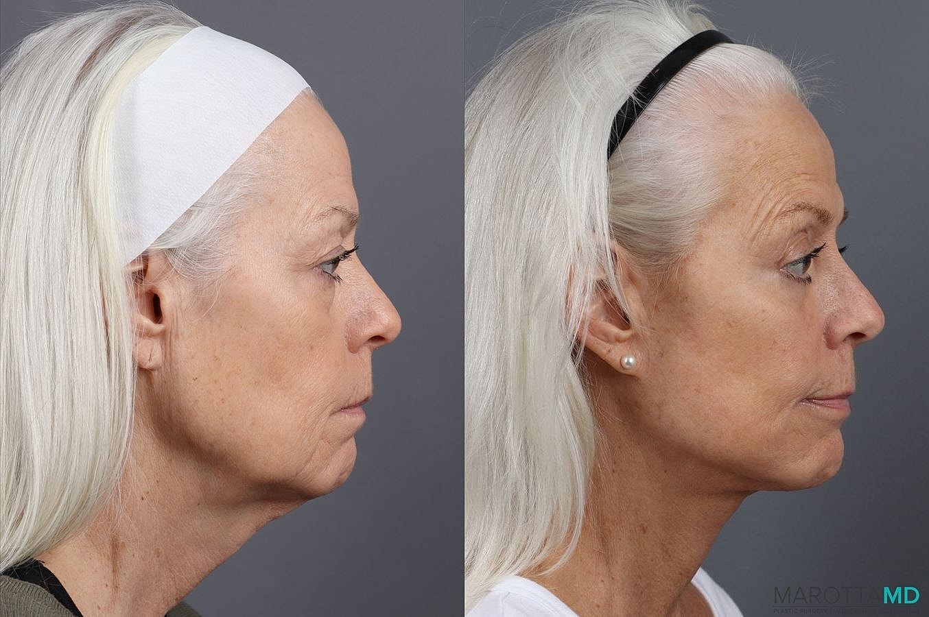 Lower Blepharoplasty Before & After