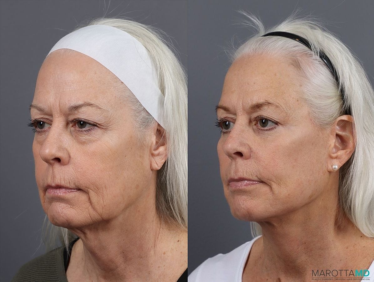 Lower Blepharoplasty Before & After