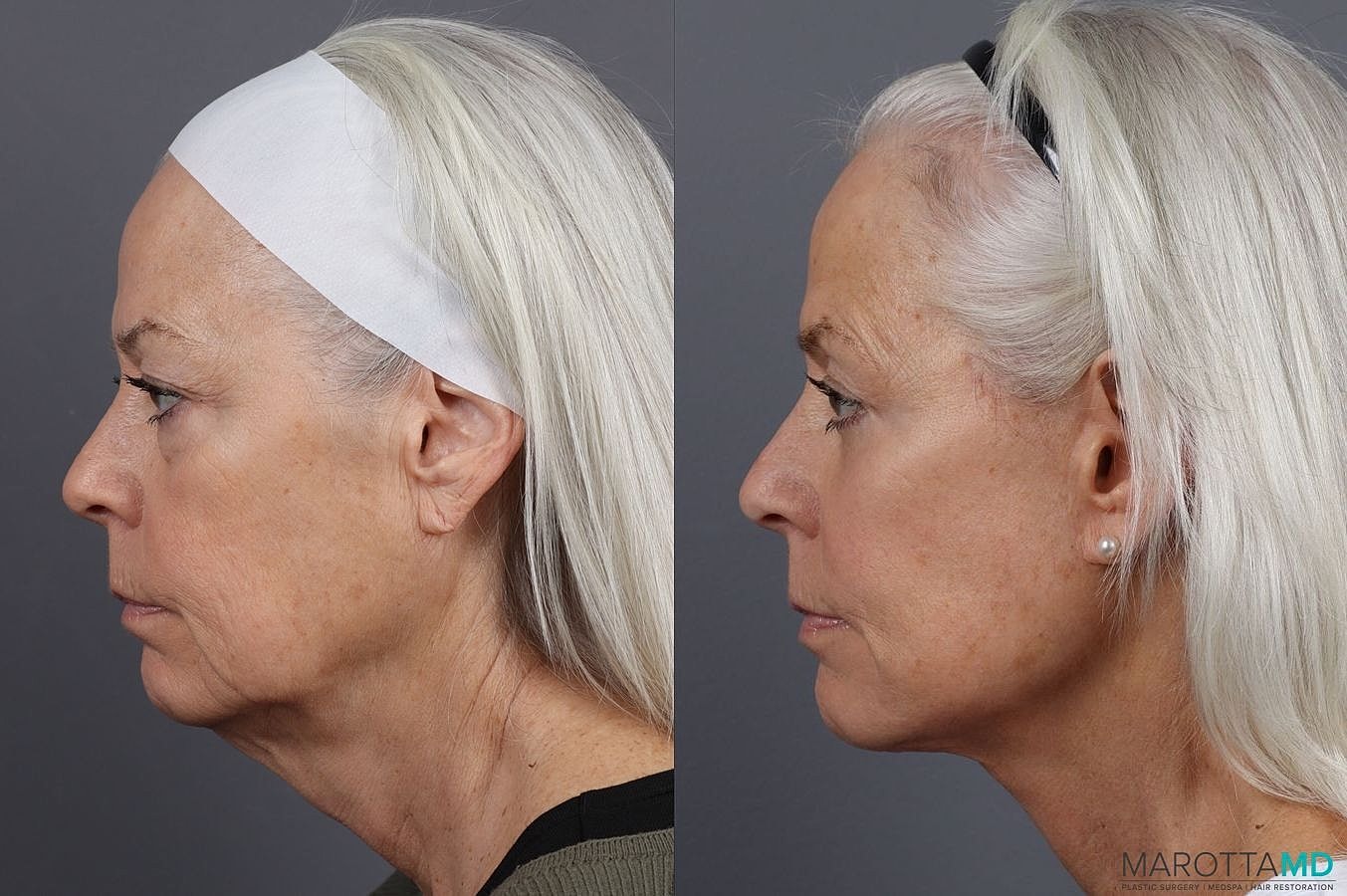 Lower Blepharoplasty Before & After