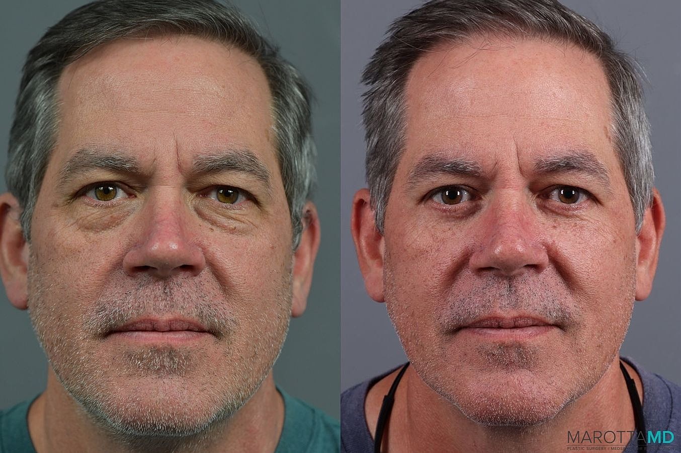 Lower Blepharoplasty Before & After