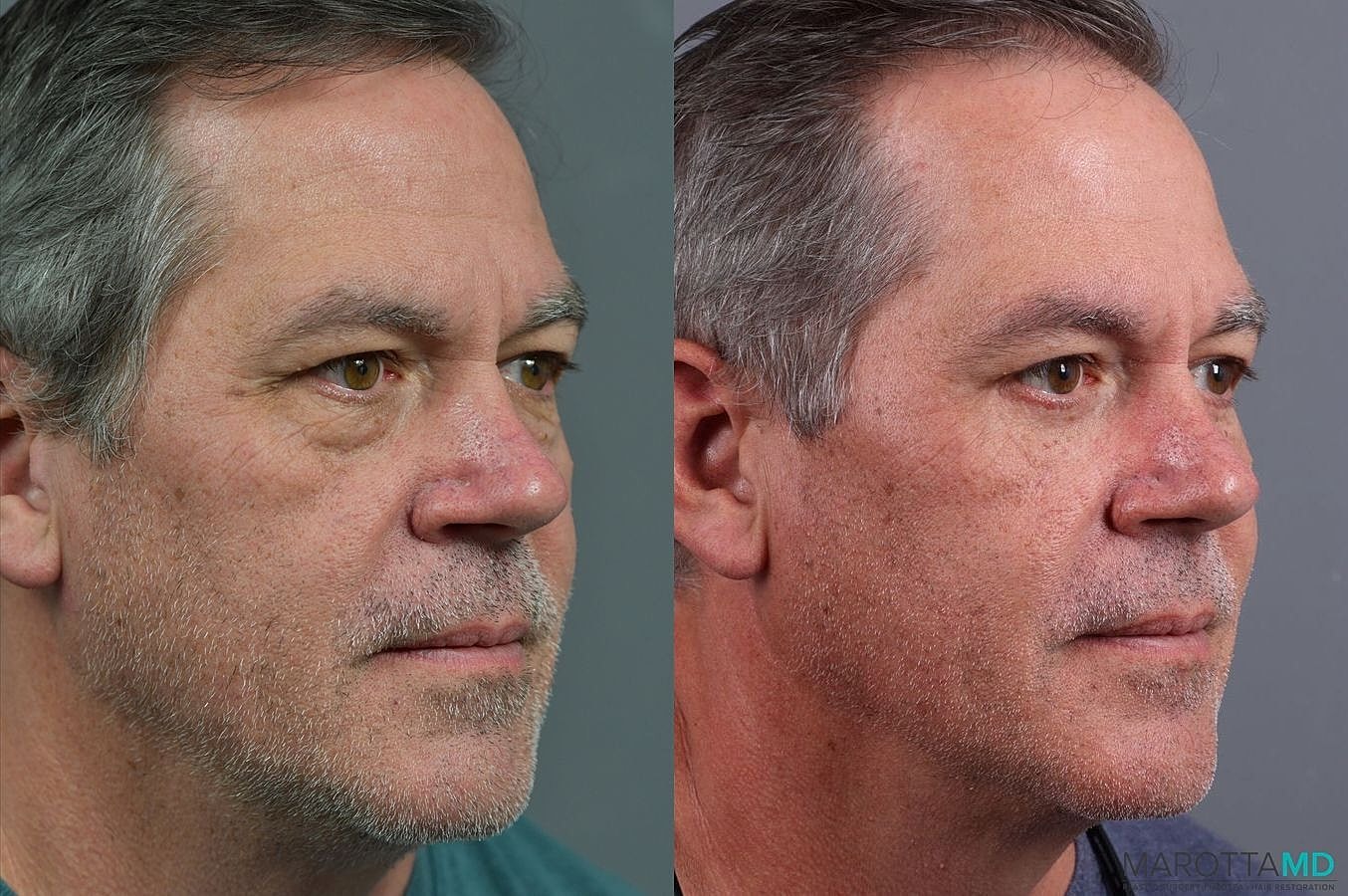 Lower Blepharoplasty Before & After