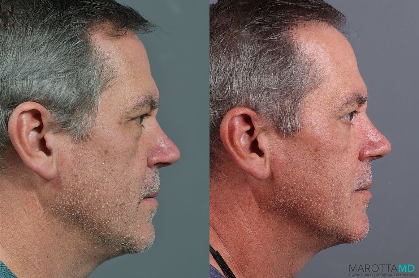 Lower Blepharoplasty Before & After