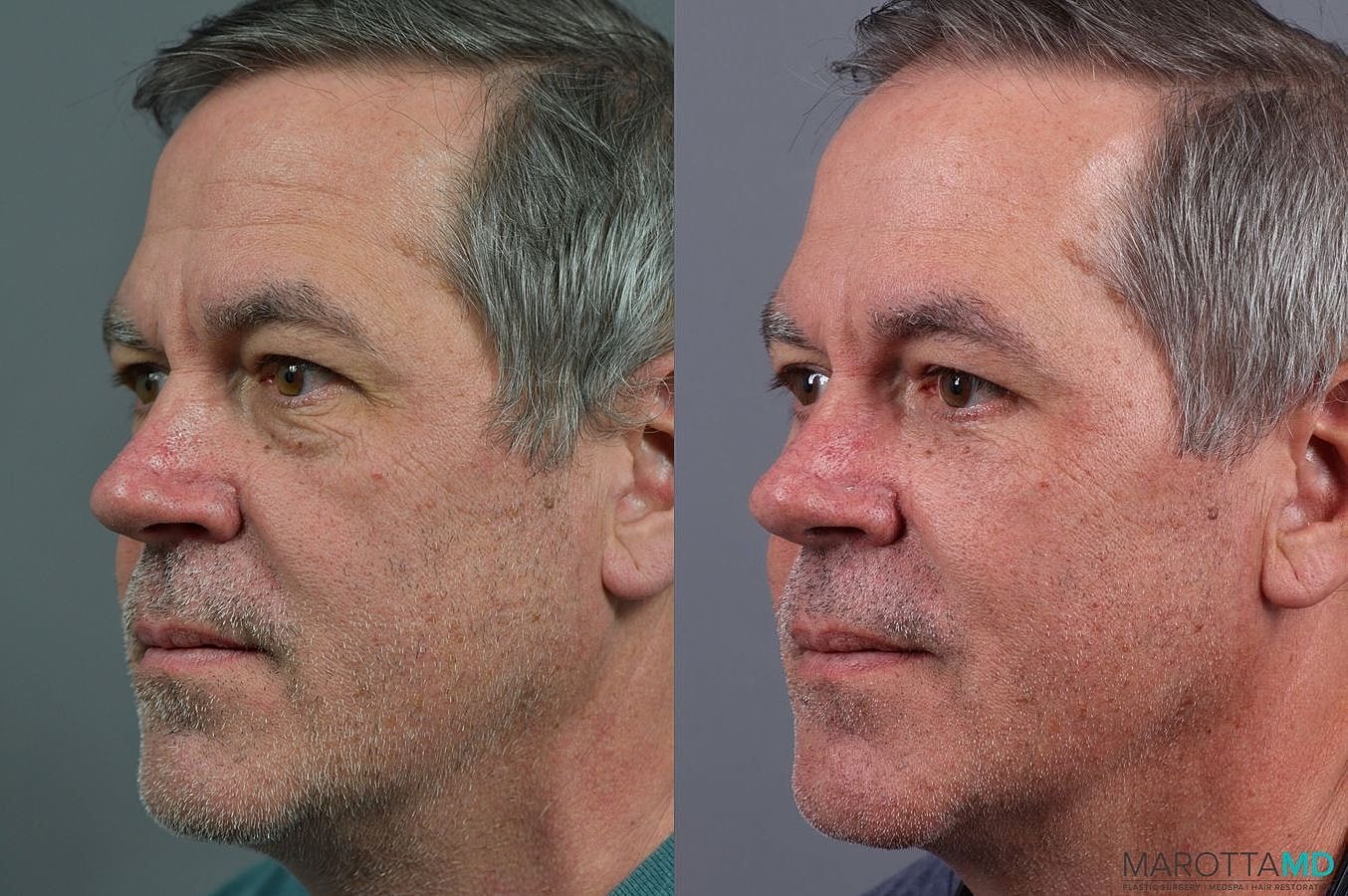 Lower Blepharoplasty Before & After