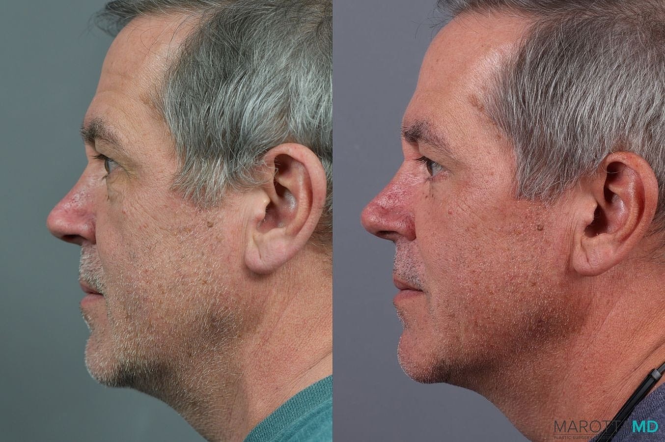 Lower Blepharoplasty Before & After