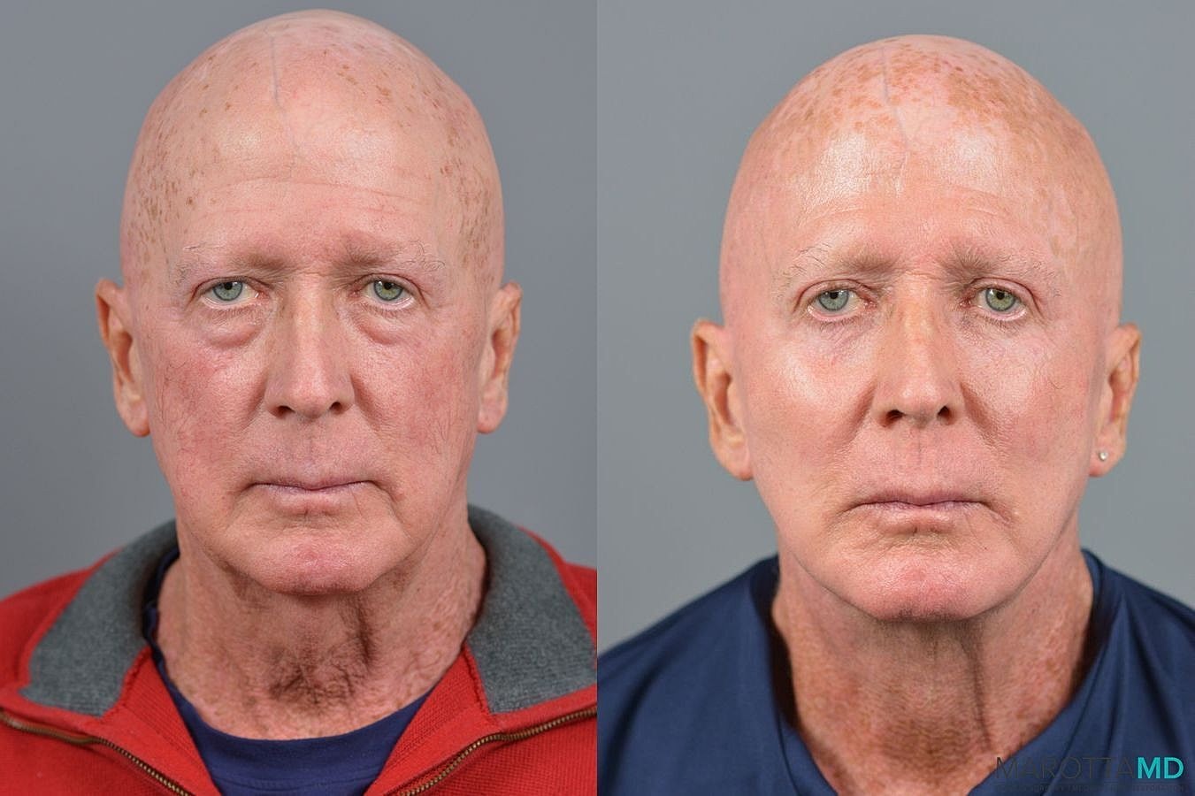 Lower Blepharoplasty Before & After