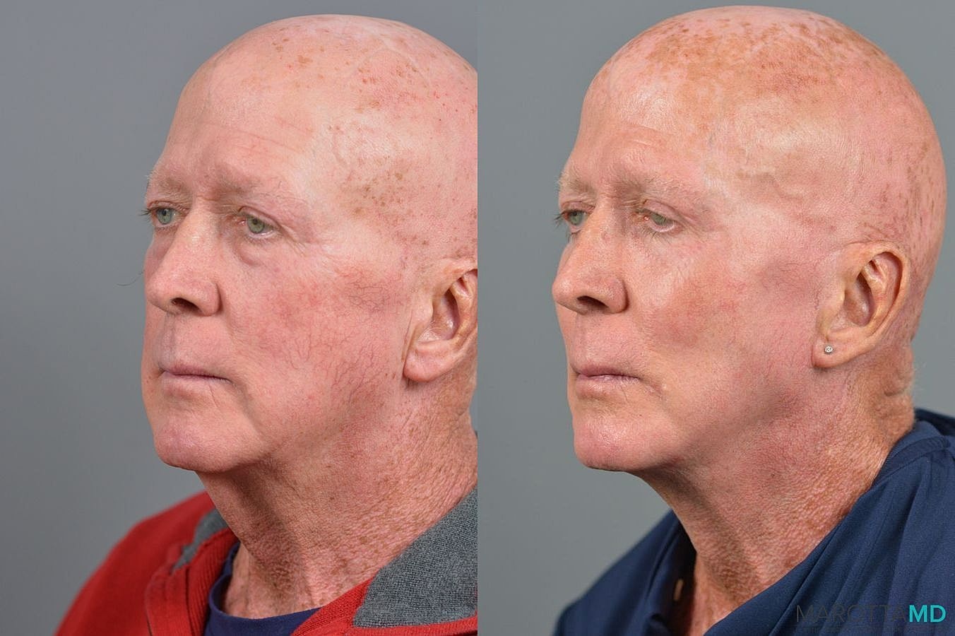 Lower Blepharoplasty Before & After