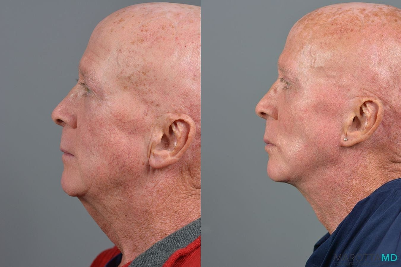 Lower Blepharoplasty Before & After