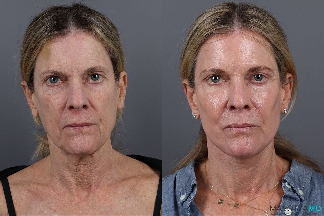 Lower Blepharoplasty Before & After