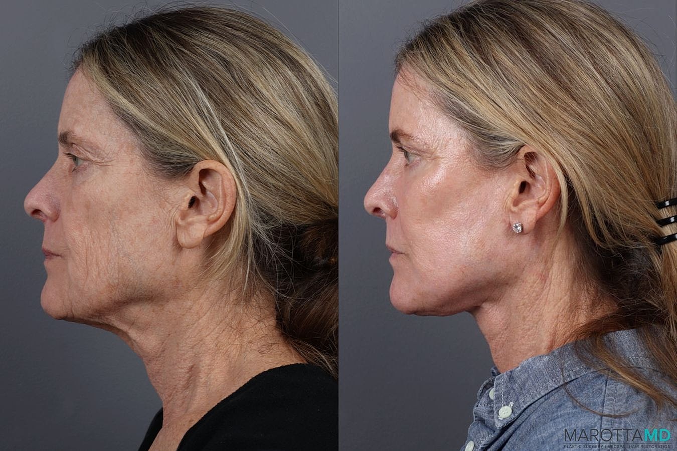 Lower Blepharoplasty Before & After