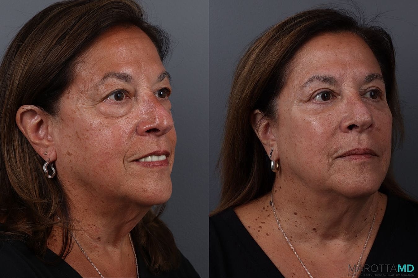 Lower Blepharoplasty Before & After