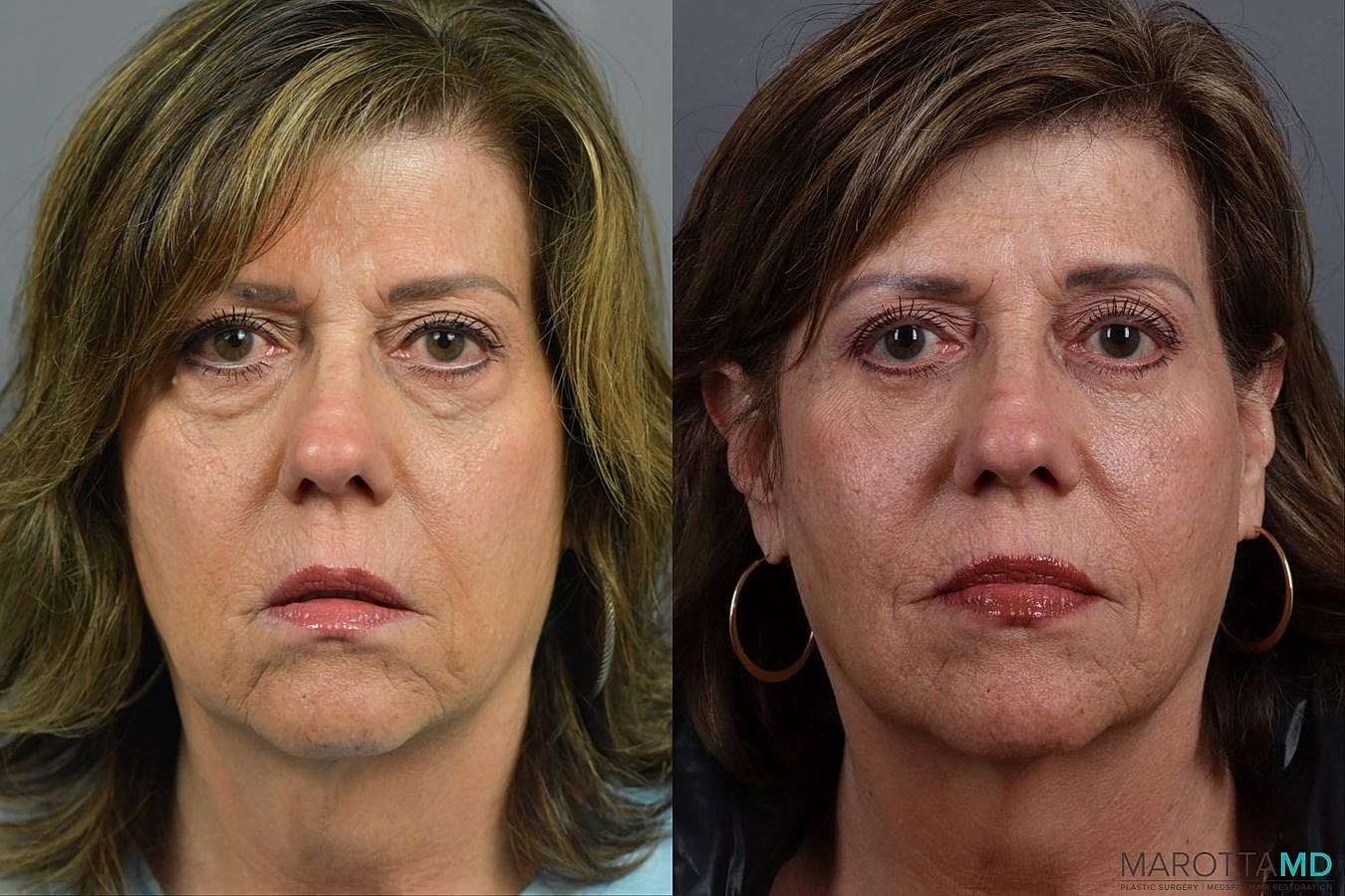 Lower Blepharoplasty Before & After