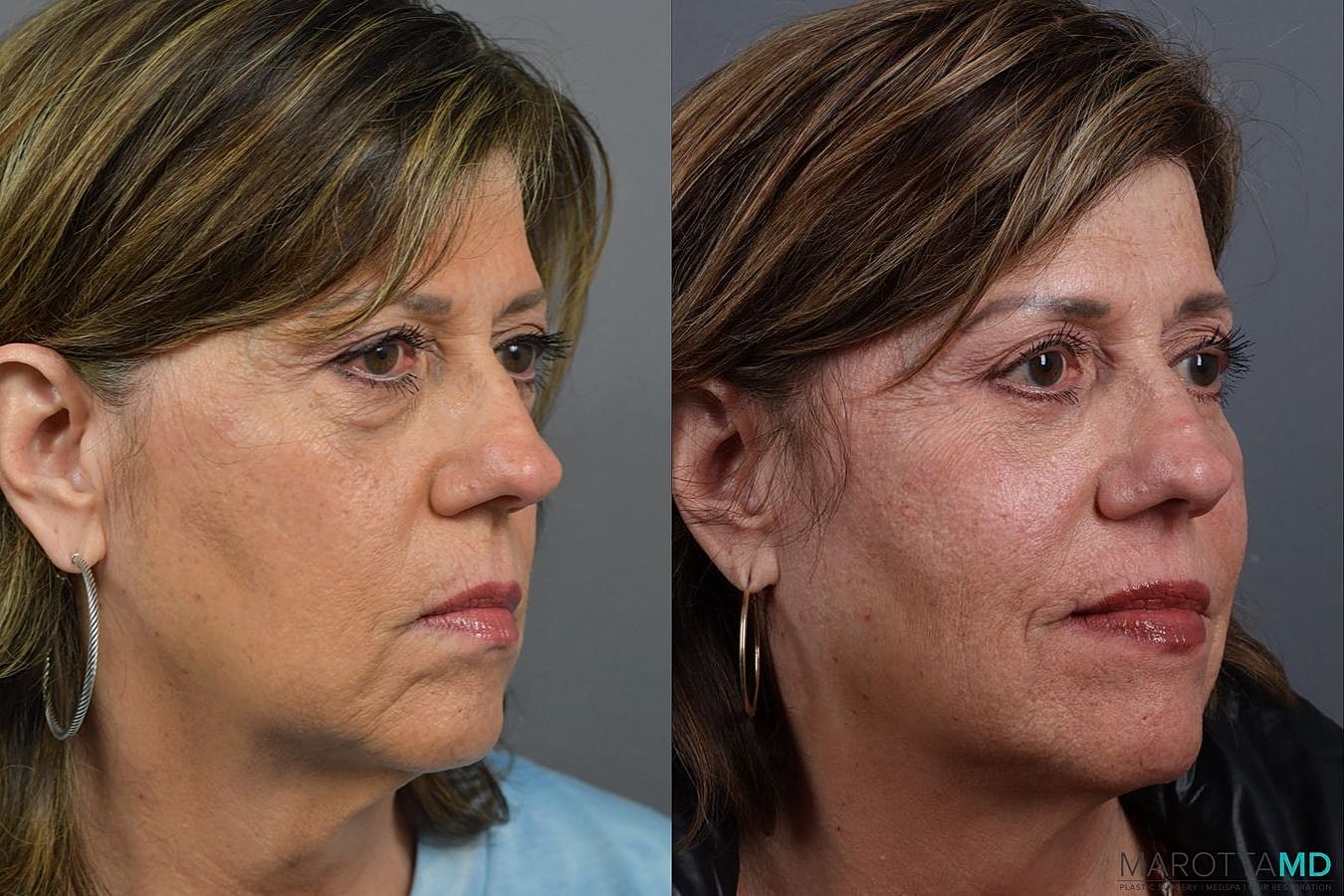 Lower Blepharoplasty Before & After
