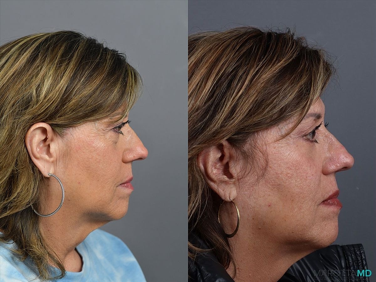 Lower Blepharoplasty Before & After