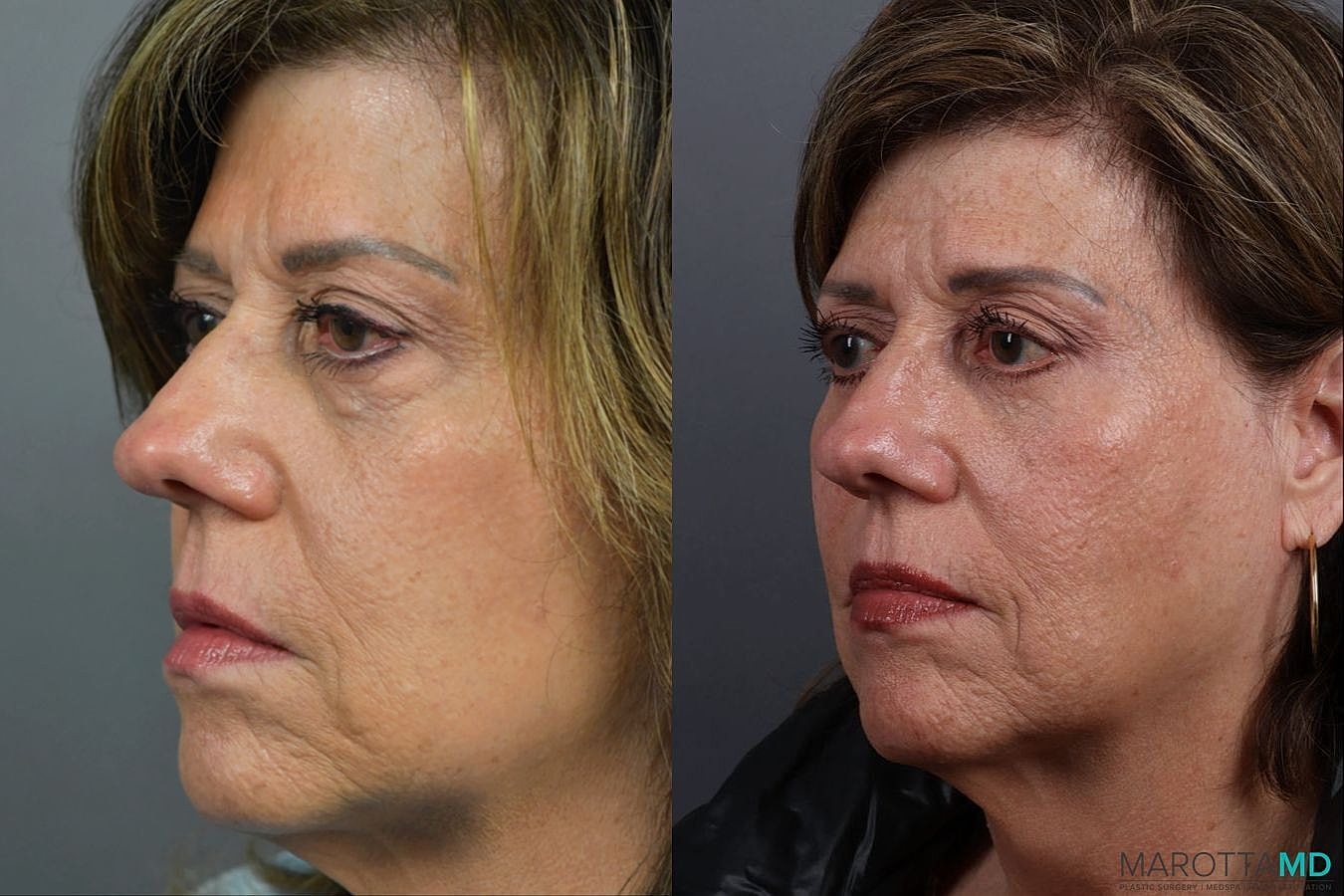 Lower Blepharoplasty Before & After