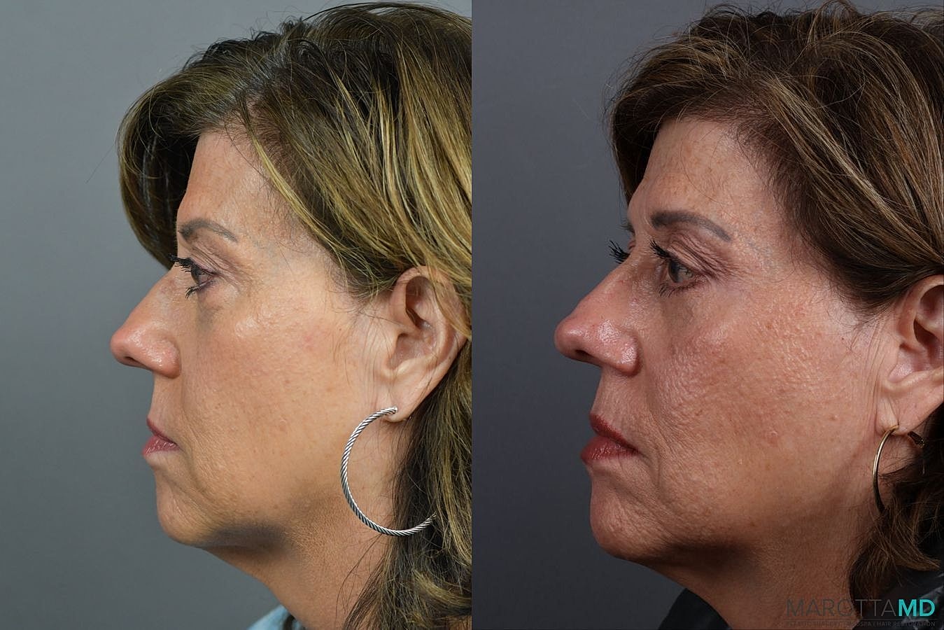 Lower Blepharoplasty Before & After