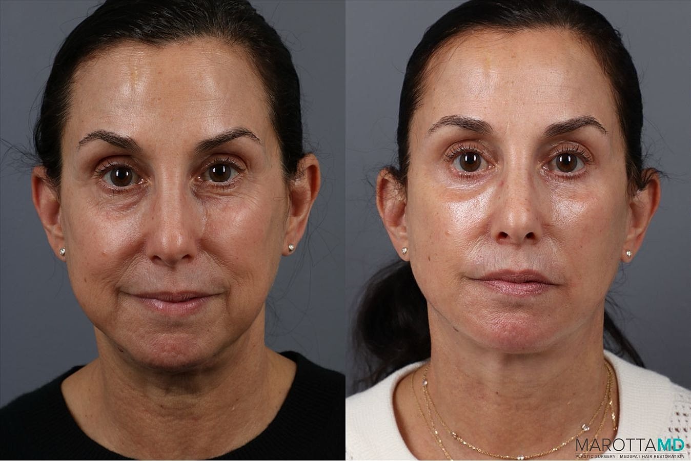 Lower Blepharoplasty Before & After