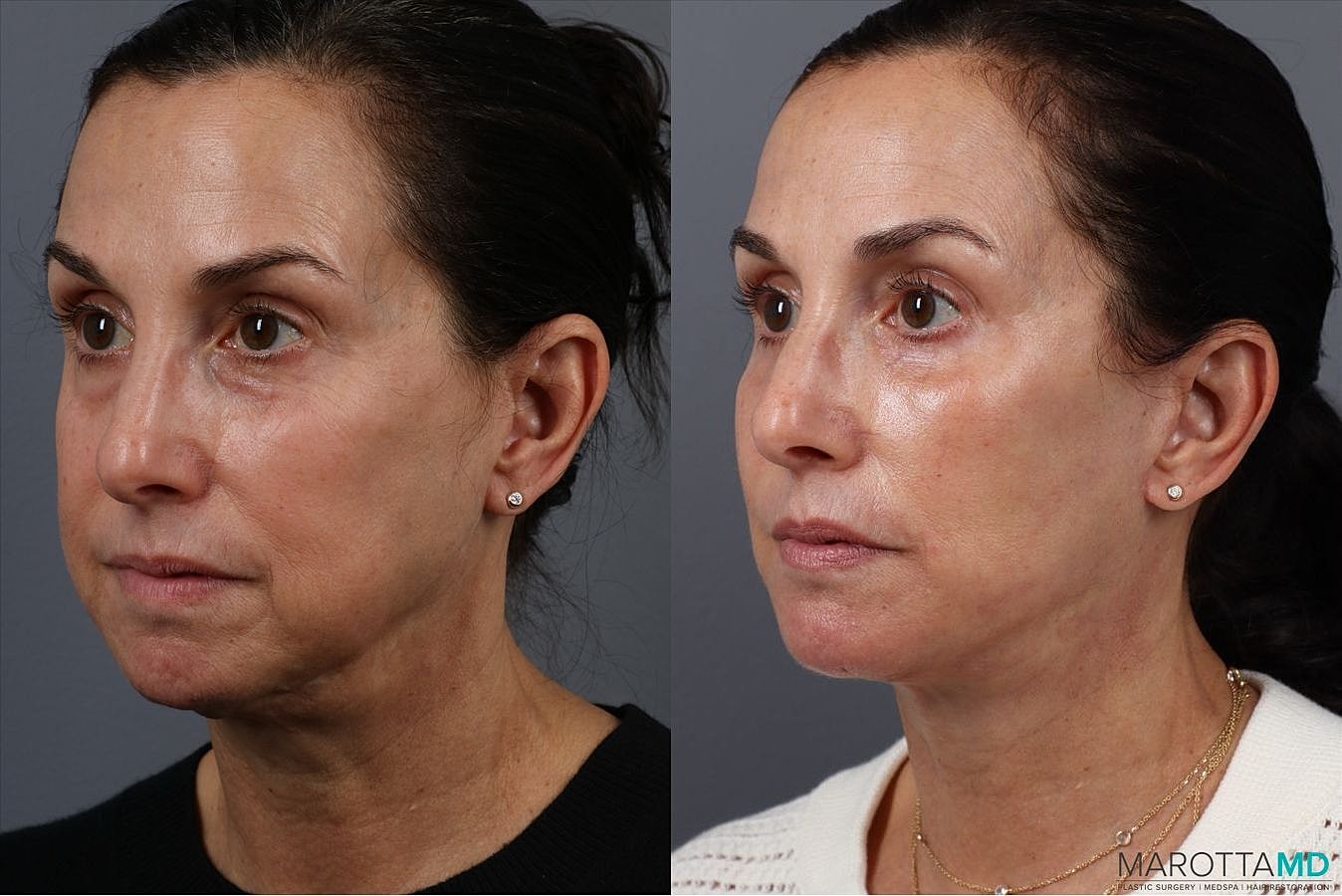 Lower Blepharoplasty Before & After