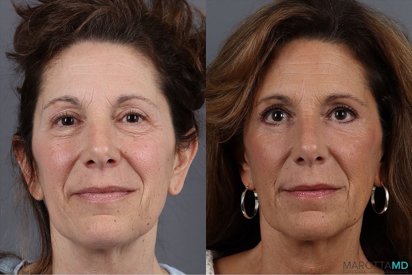 Lower Blepharoplasty Before & After