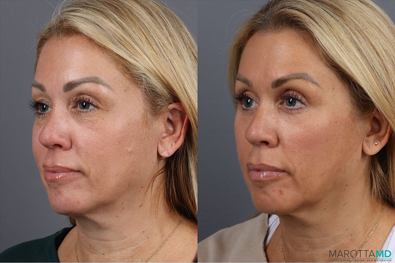 Lower Blepharoplasty Before & After