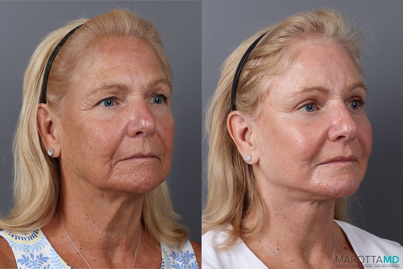 Lower Blepharoplasty Before & After