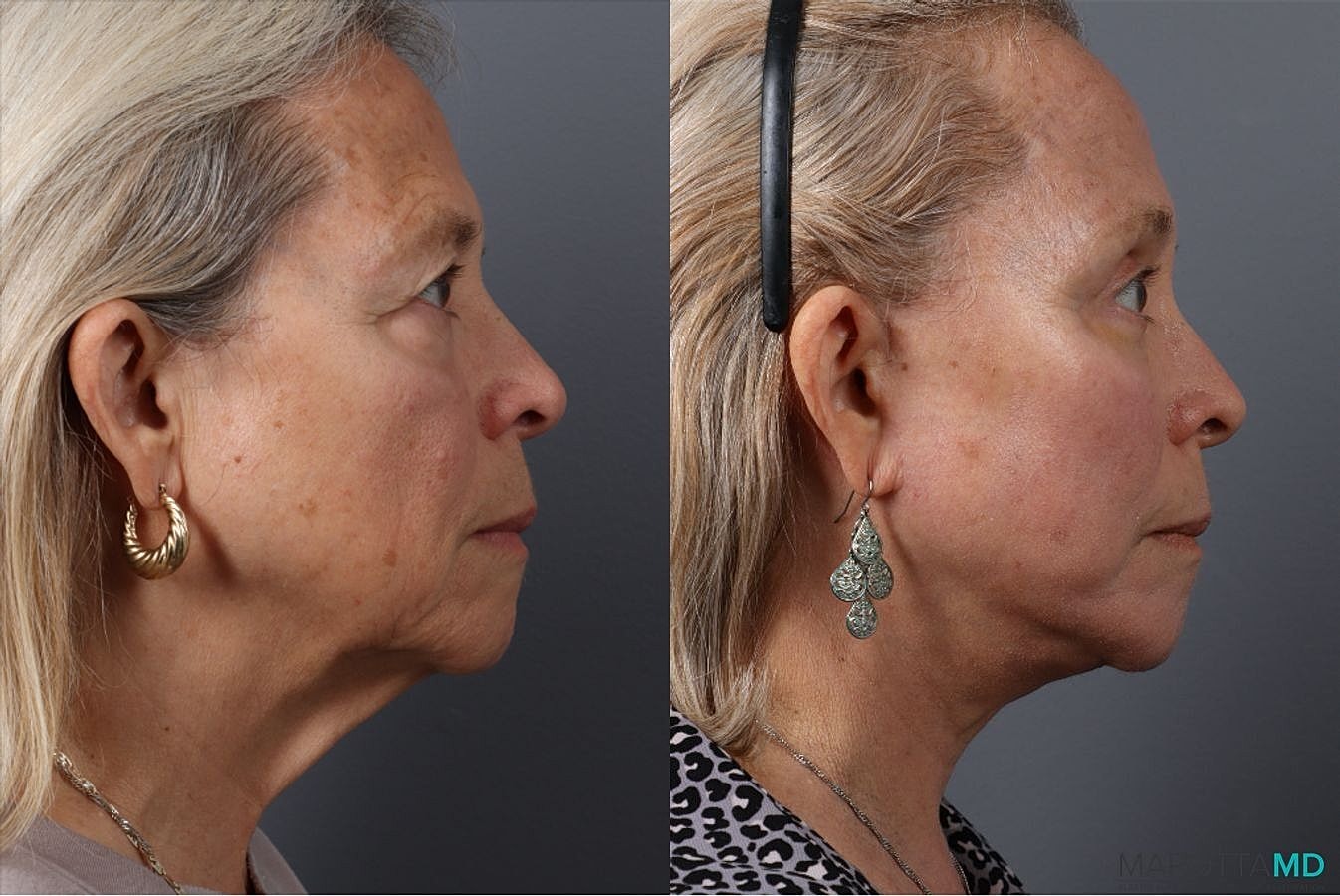 Lower Blepharoplasty Before & After