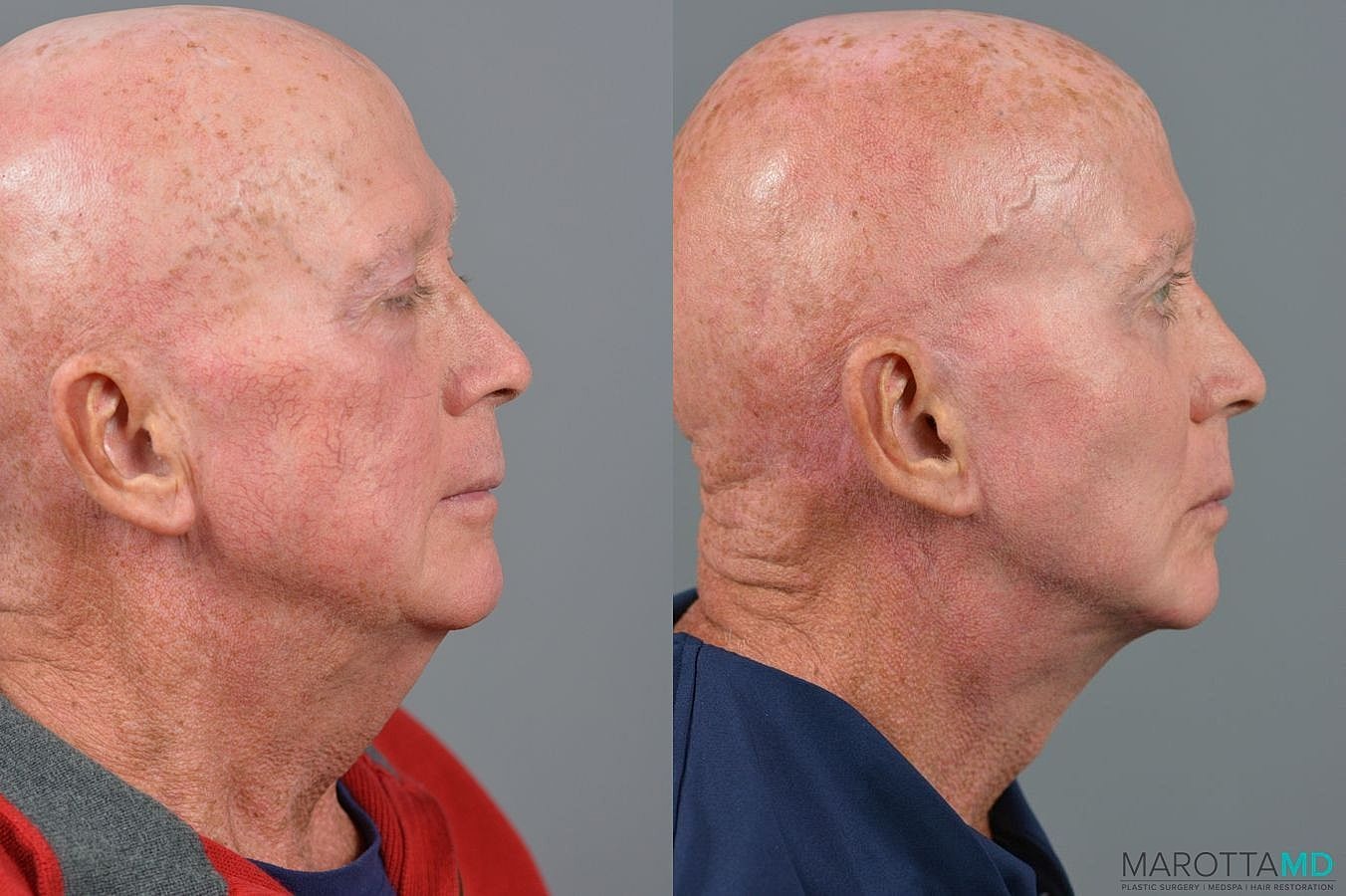 Cheek Augmentation Before & After