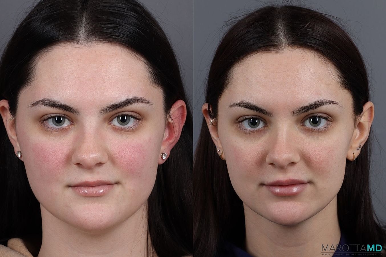 Dermal Fillers Before & After