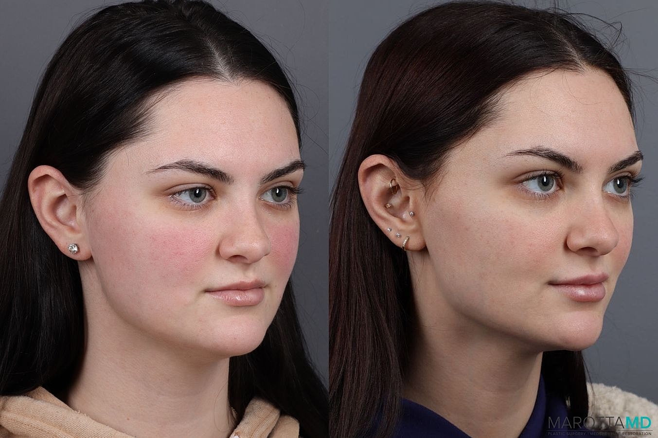 Dermal Fillers Before & After