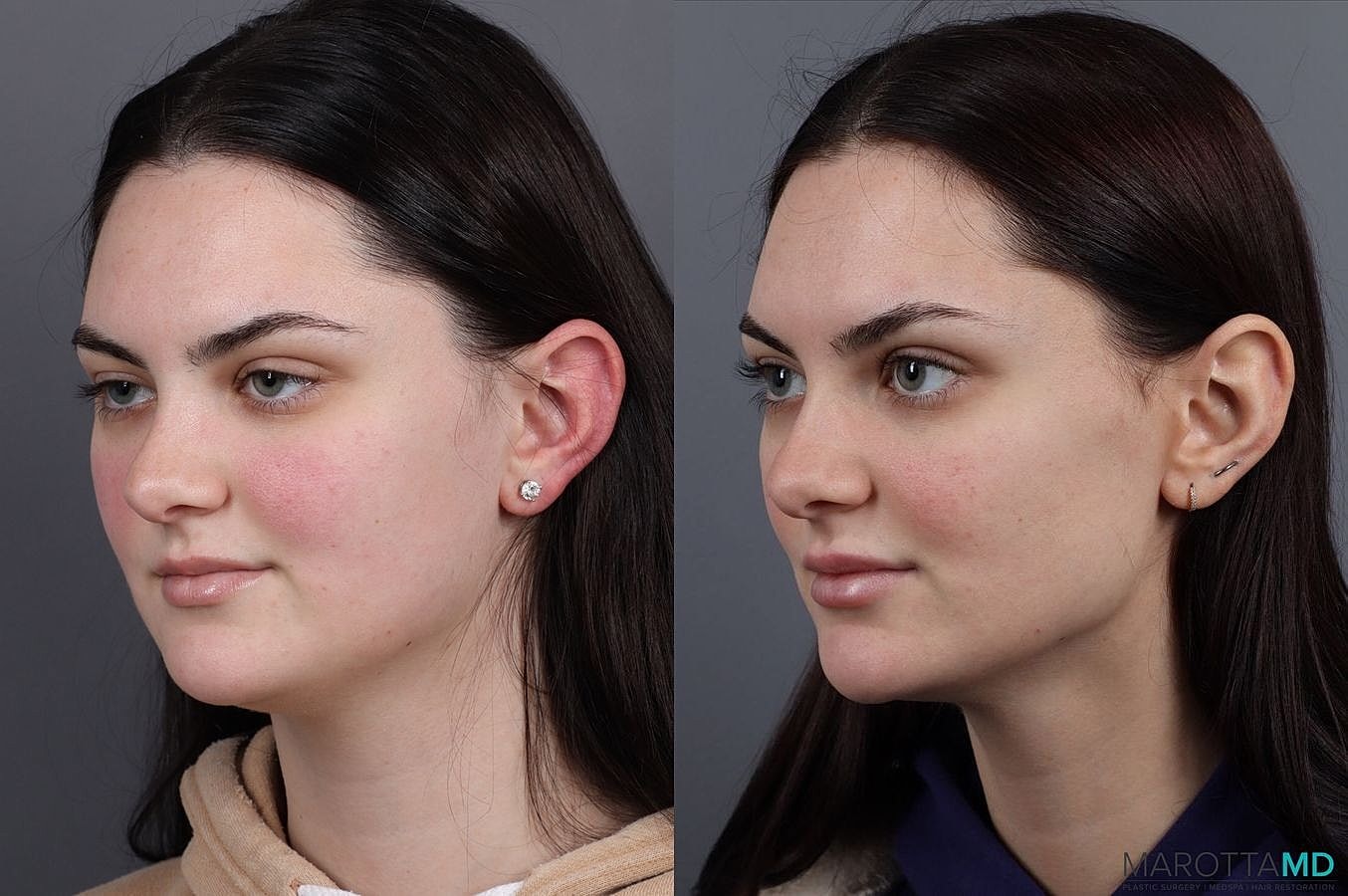 Dermal Fillers Before & After