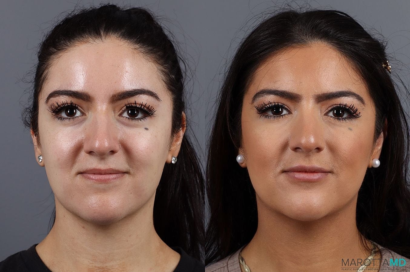Dermal Fillers Before & After