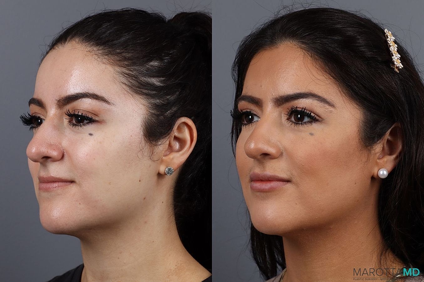 Dermal Fillers Before & After