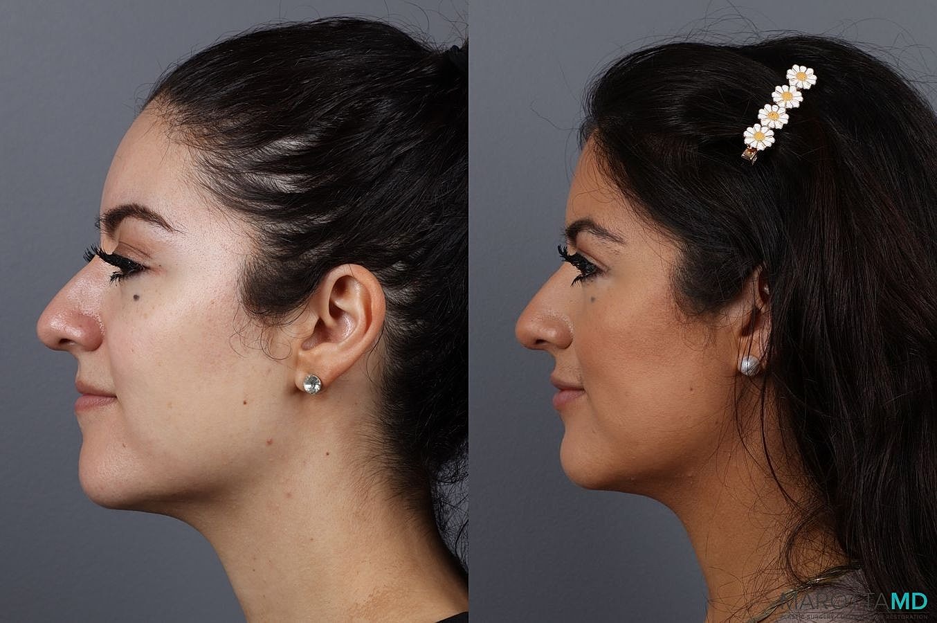 Dermal Fillers Before & After