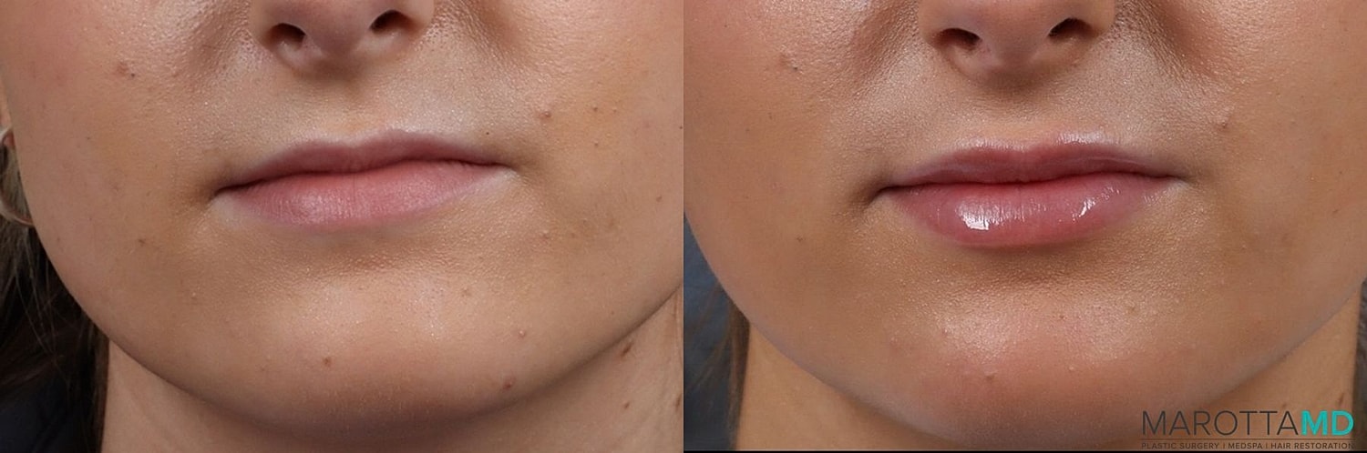 Dermal Fillers Before & After