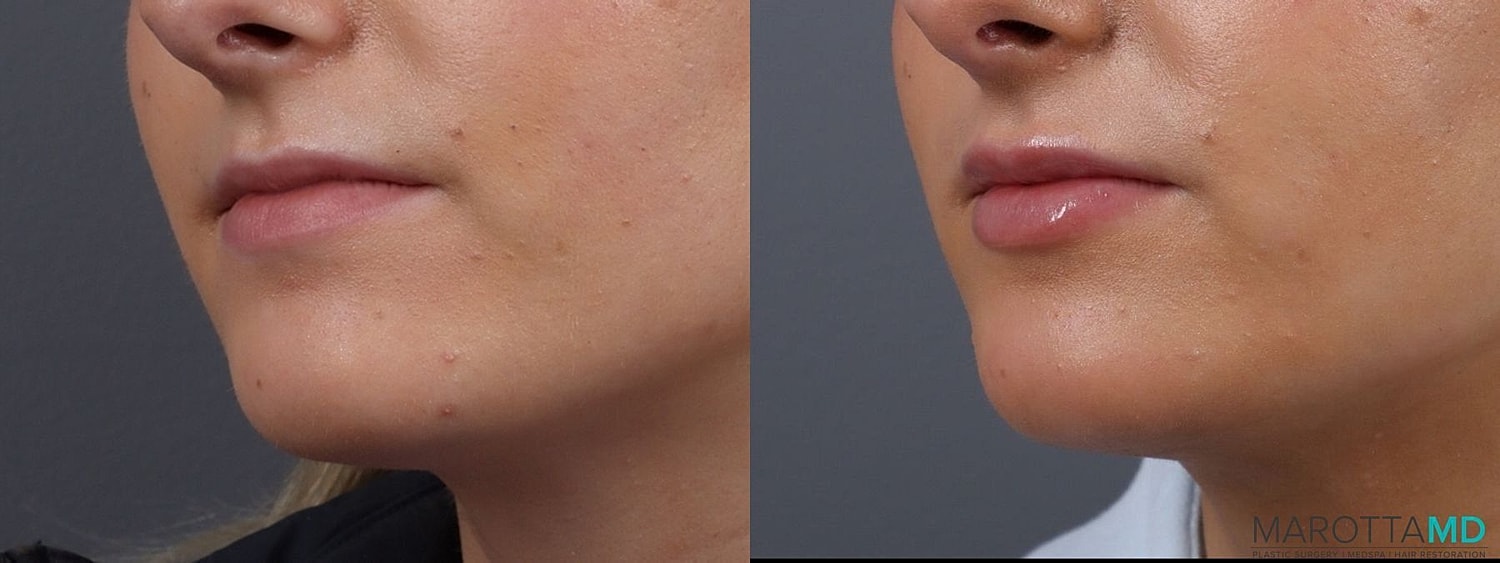 Dermal Fillers Before & After