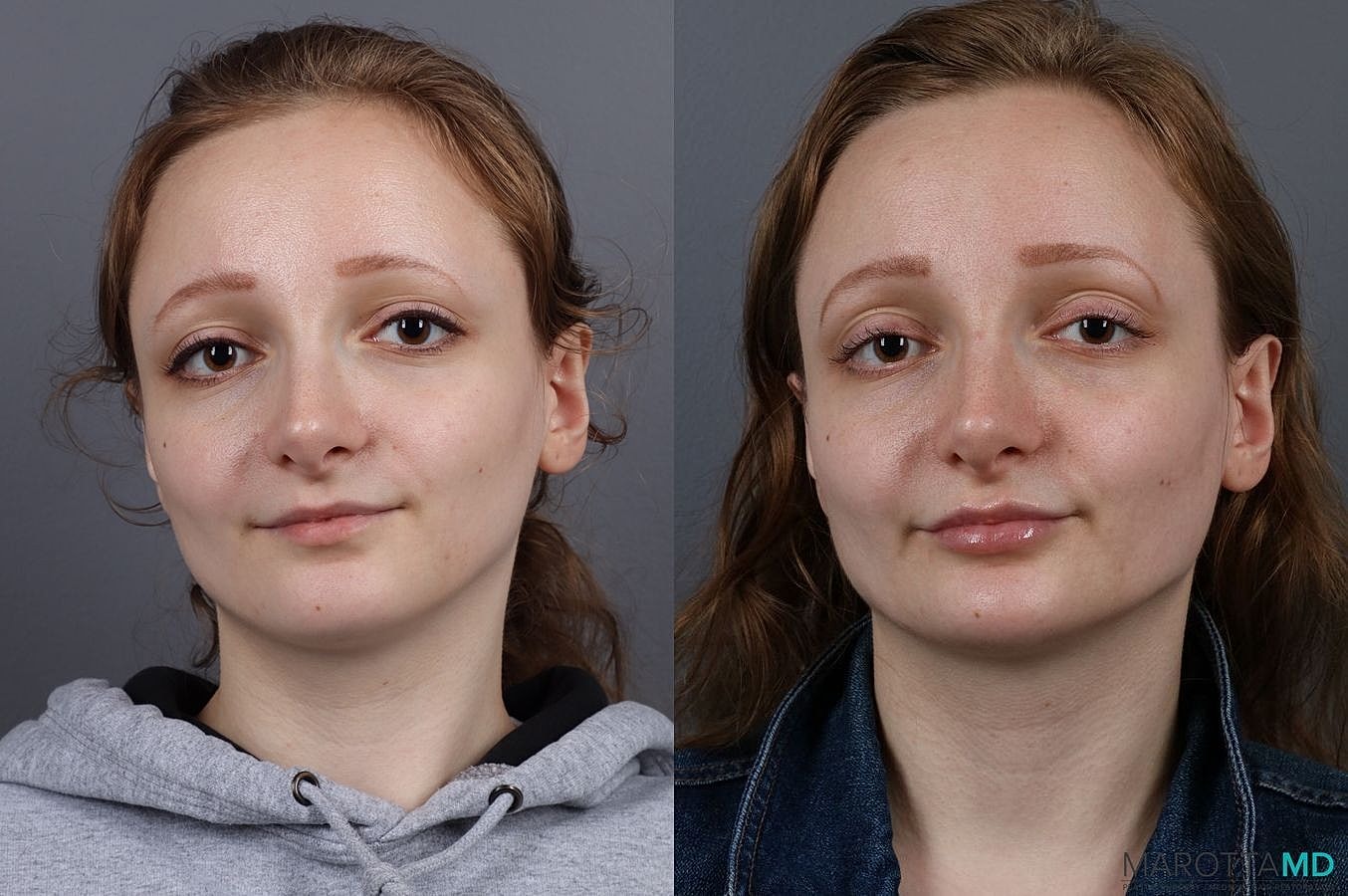 Dermal Fillers Before & After