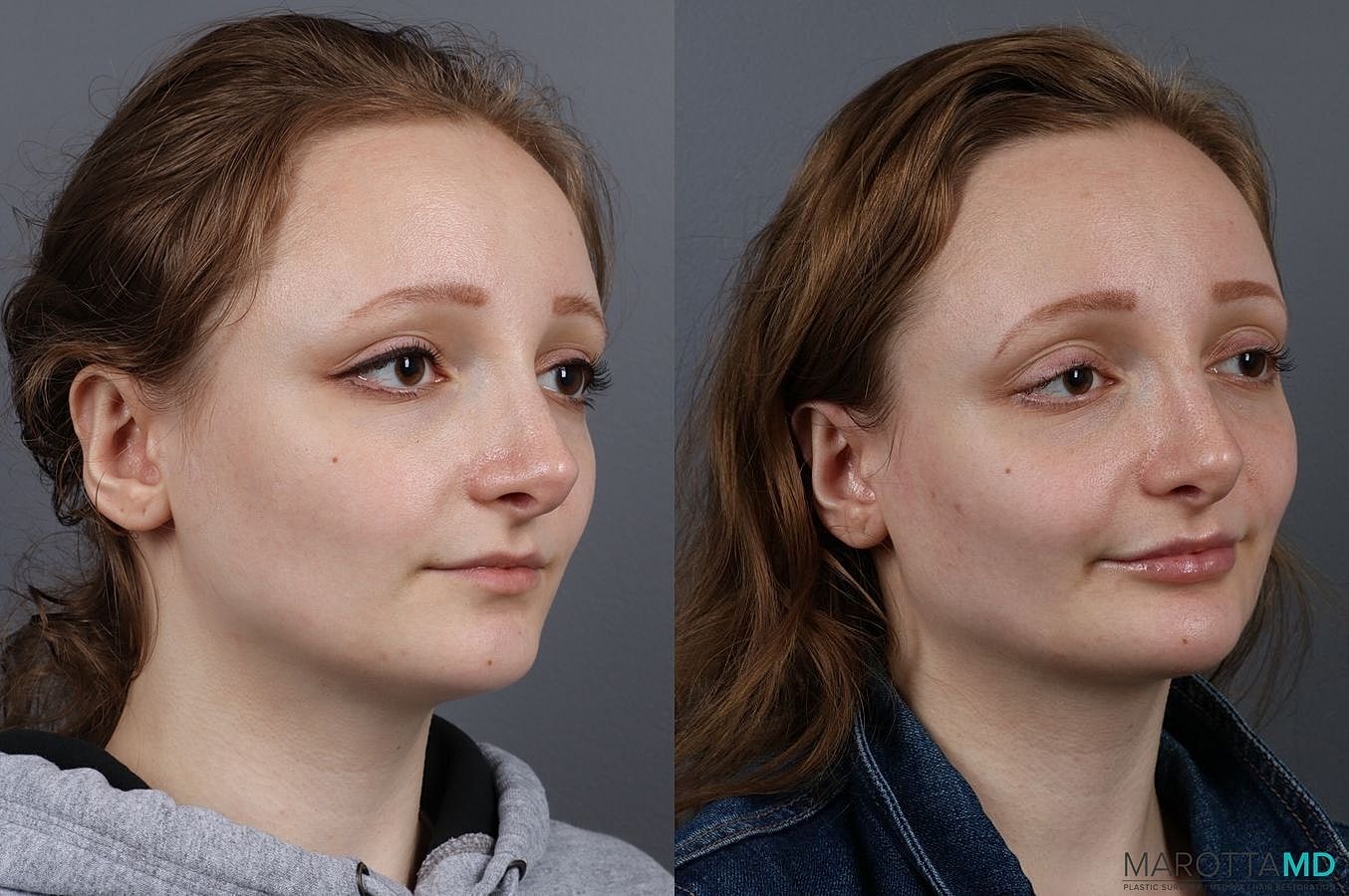 Dermal Fillers Before & After