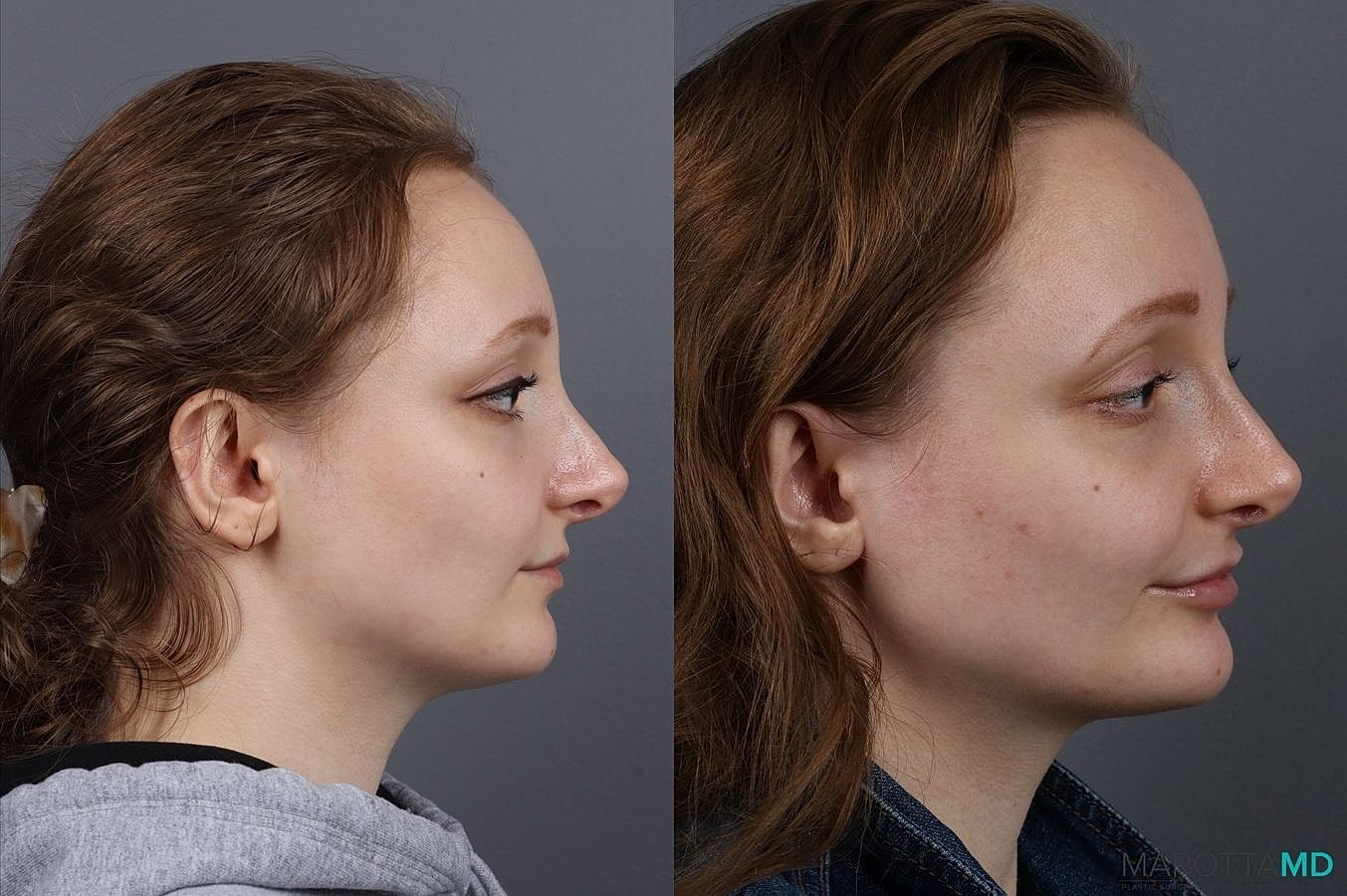 Dermal Fillers Before & After