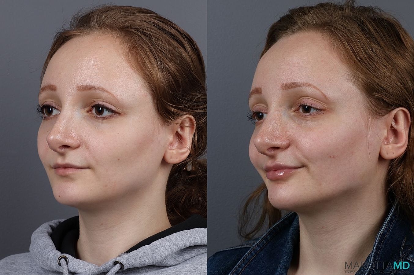 Dermal Fillers Before & After