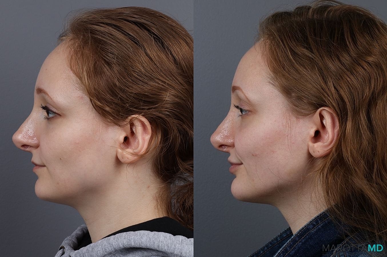 Dermal Fillers Before & After