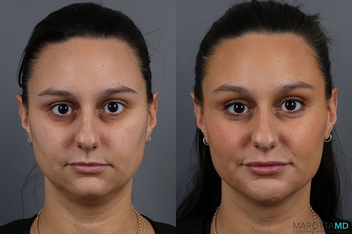 Dermal Fillers Before & After