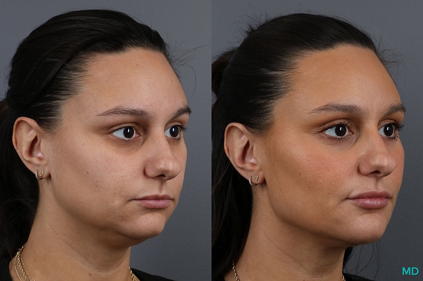 Dermal Fillers Before & After