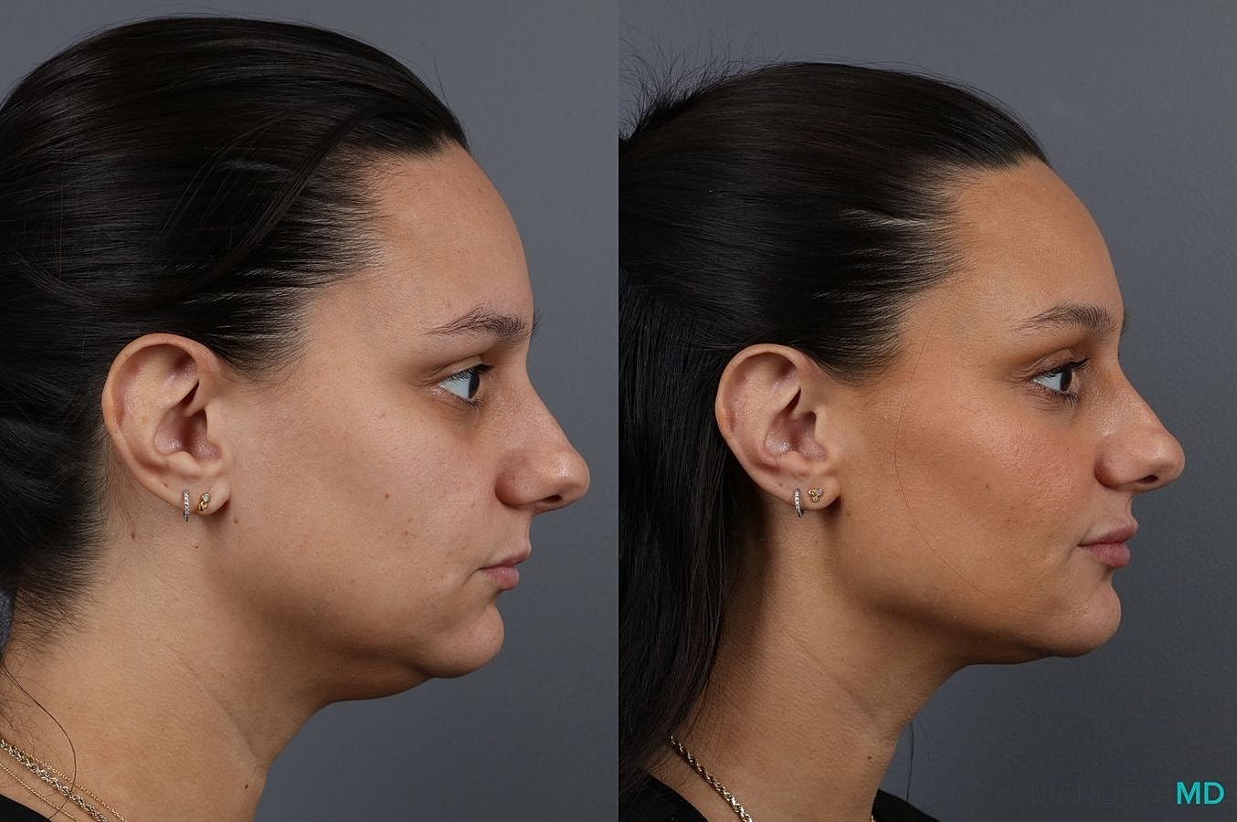 Dermal Fillers Before & After