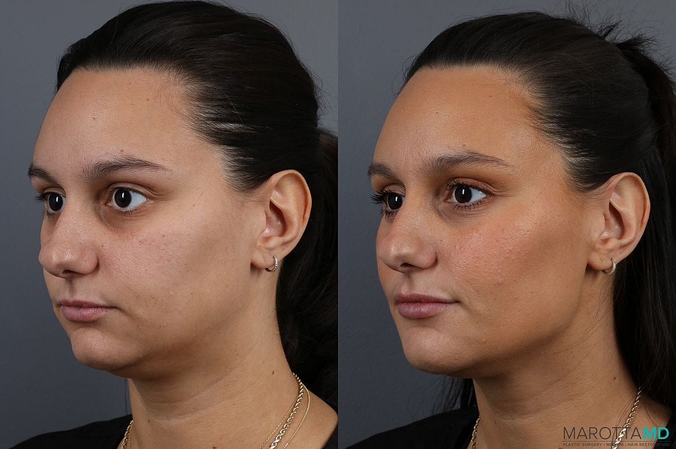 Dermal Fillers Before & After