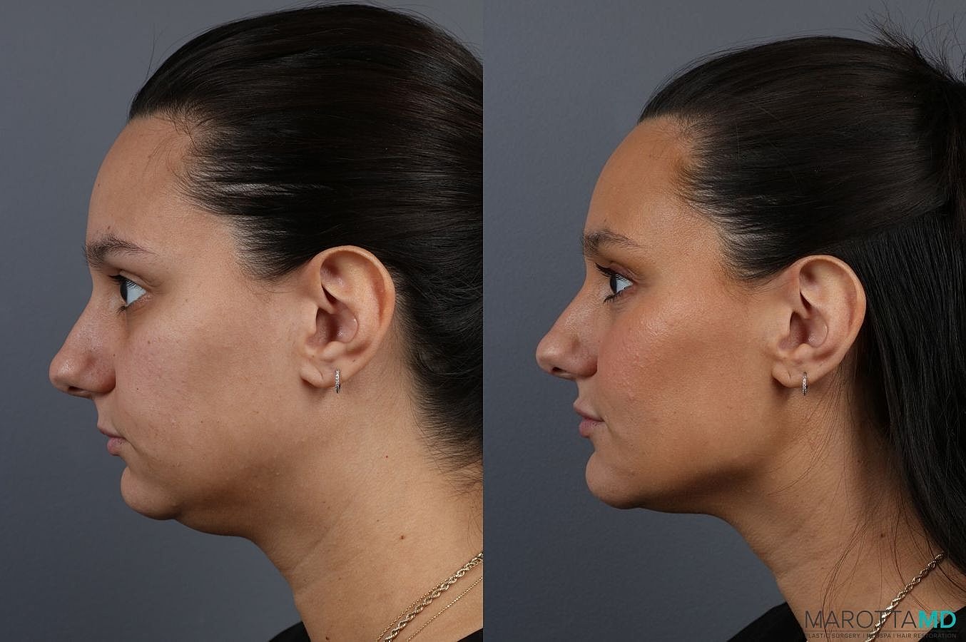 Dermal Fillers Before & After