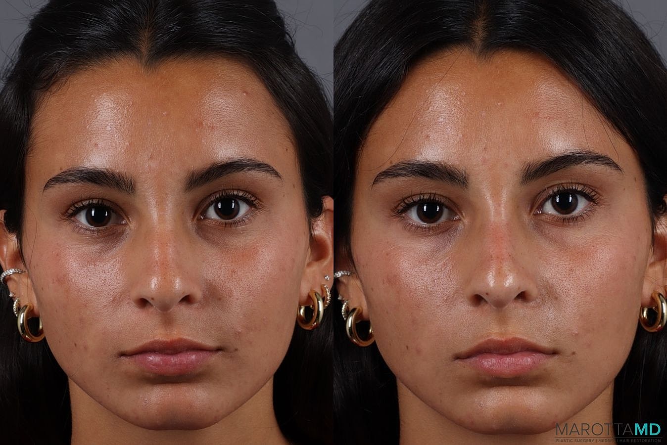 Dermal Fillers Before & After