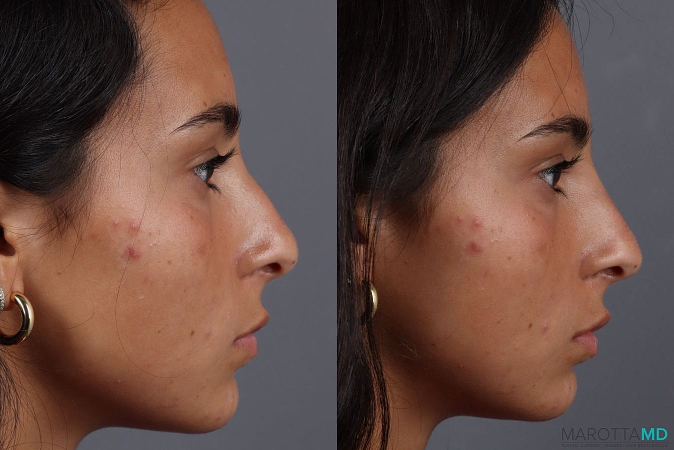 Dermal Fillers Before & After