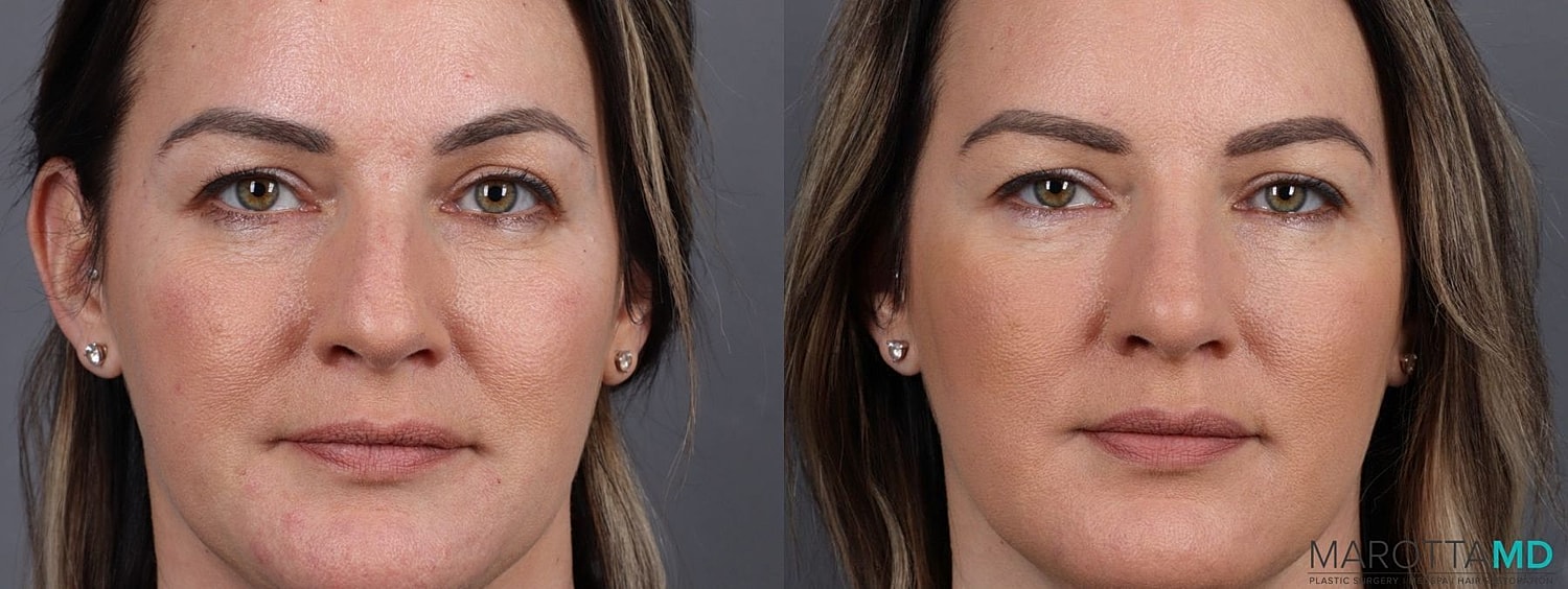 Dermal Fillers Before & After