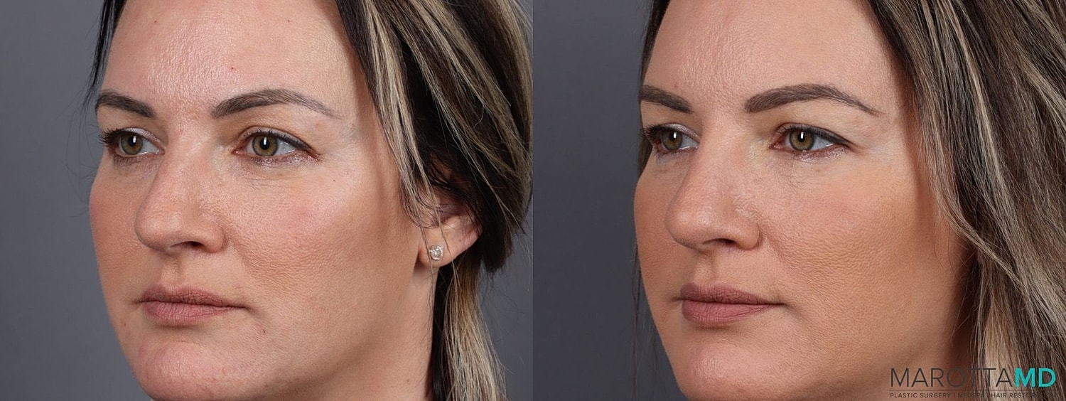 Dermal Fillers Before & After