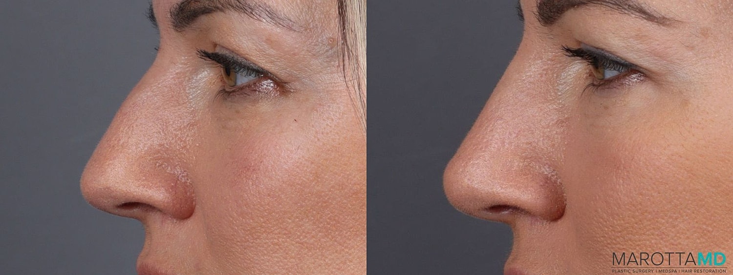 Dermal Fillers Before & After