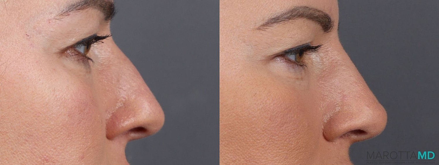 Dermal Fillers Before & After